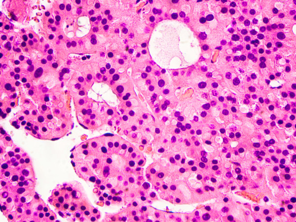Cellule epatiche con carcinoma epatocellulare