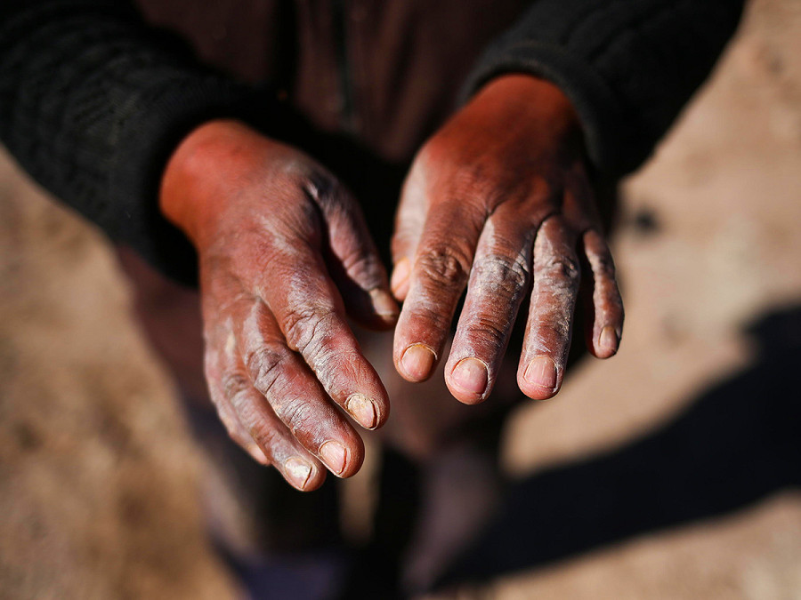 San Agustin de Punaca (Bolivia). Una donna mostra le mani dopo aver maneggiato l’acqua adibita al consumo quotidiano. La sua comunit&agrave; boliviana incolpa l’industria mineraria per la contaminazione da arsenico e ha deciso di portarla in tribunale per denunciare il presunto danno ambientale.