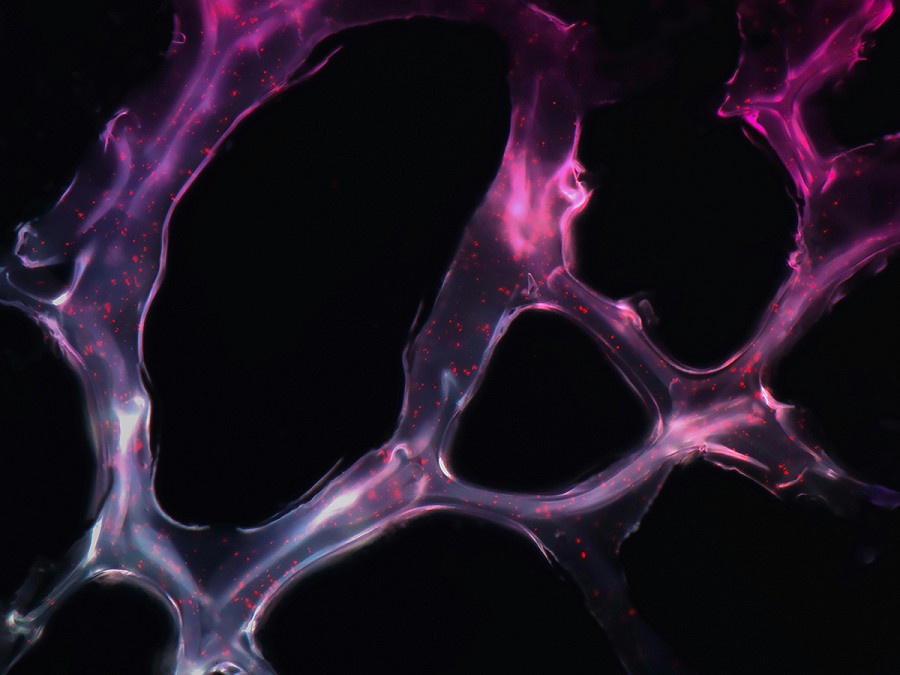 Una ricerca pubblicata su &ldquo;Cancer Cell&rdquo; del Cold Spring Harbor Laboratory ha scoperto che lo stress porterebbe alcuni globuli bianchi chiamati neutrofili a formare strutture appiccicose che rendono i tessuti corporei pi&ugrave; suscettibili alle metastasi, aumentando il rischio di tumori. 