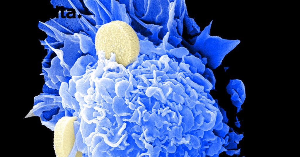 Uk: il nuovo trattamento per curare il cancro al seno